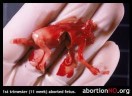 avortement.jpg